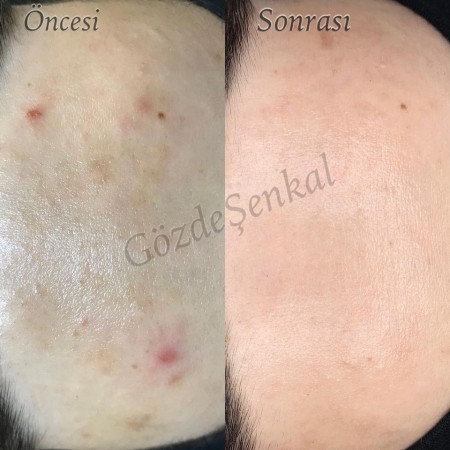 Gözde Şenkal | Güzellik Uzmanı | Kalıcı Makyaj Uygulamaları