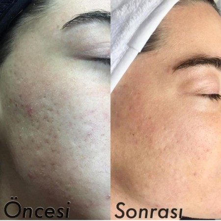 Gözde Şenkal | Güzellik Uzmanı | Kalıcı Makyaj Uygulamaları